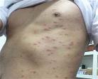 过敏性红疹图片